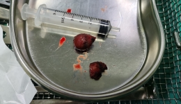 治病又爱美  南溪山医院运用口腔镜“无痕”切除甲状腺肿瘤