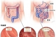 肠道不会“喊痛”！ 警惕炎症性肠病