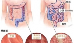 肠道不会“喊痛”！ 警惕炎症性肠病