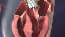 开胸进行心脏换瓣手术 南溪山医院独立完成两台高难度TAVR