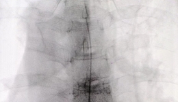 顽固性疼痛患者福音  南溪山医院完成桂北首例全植入式鞘内药物灌注系统植入手术