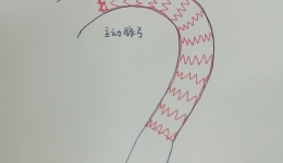 南溪山医院运用大血管杂交手术成功救治主动脉弓部瘤患者