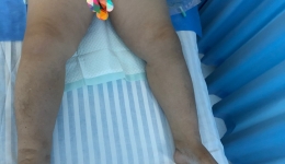 “淋”危不惧  “肿”有办法