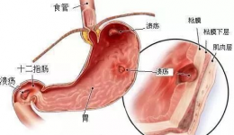 如何让消化性溃疡远离自己？