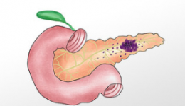 如何预防胰腺炎？