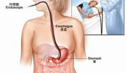 胃肠息肉健康宣教