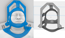 南溪山医院运用3D打印与光学追踪技术为幽闭症患者精准放疗