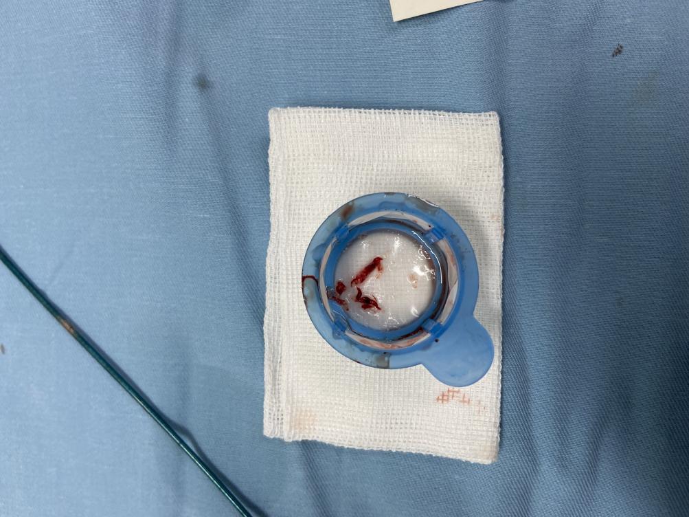 2.为患者取出的血栓