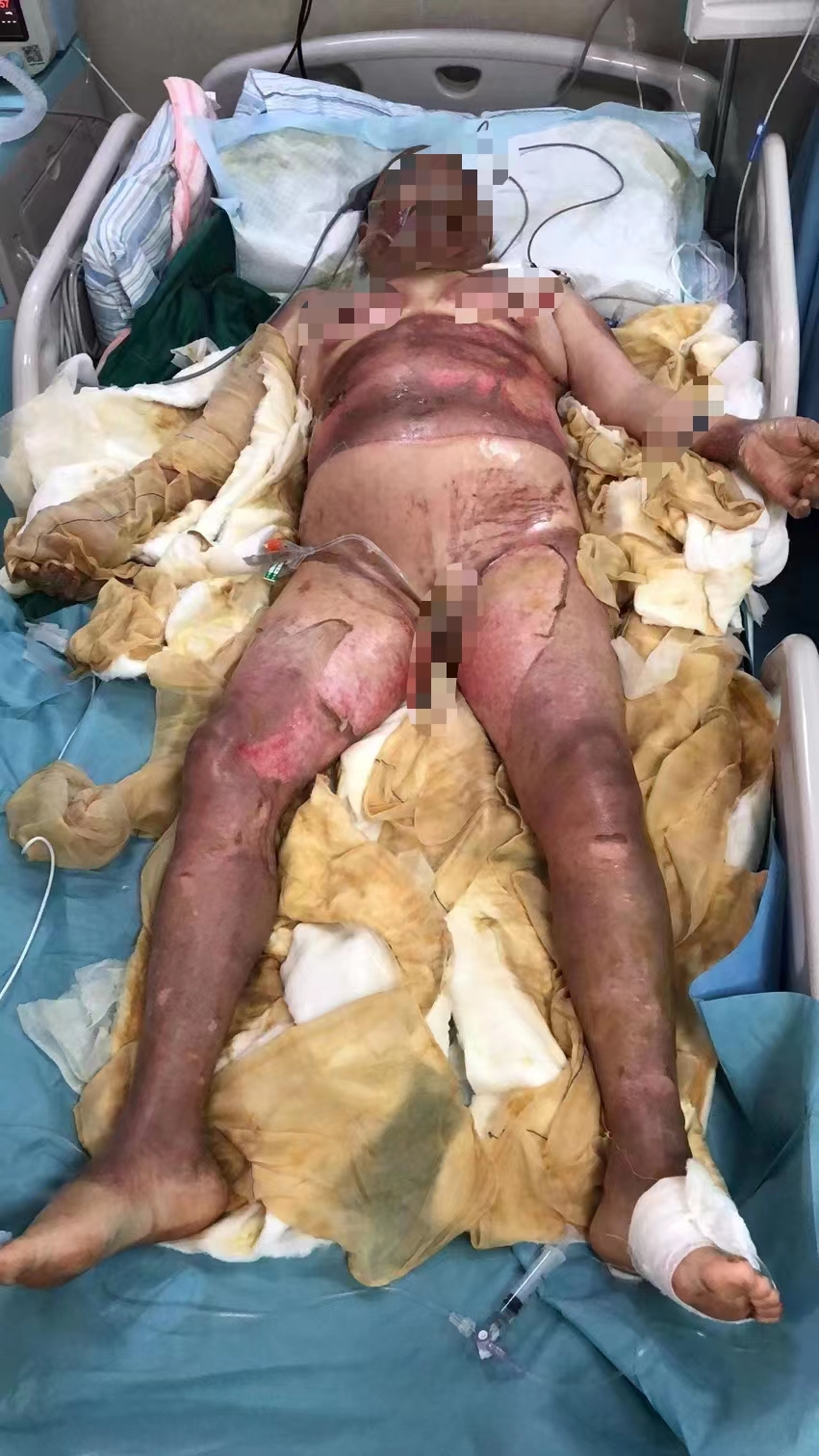 1.兰阿姨刚入院时,全身大面积烧伤达80%