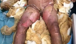 妙手仁心救危难 烧伤患者迎新生