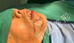 男子被电锯割伤“颜面尽失”医生美容缝合为其保住“脸面”