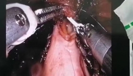 自治区南溪山医院运用手术机器人为患者重造“新膀胱”