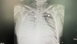 国内罕见|屠宰活羊感染罕见病原体！ 南溪山医院运用ECMO抢救患者生命