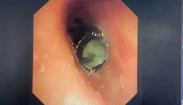 小笔头险酿大祸  11岁男童反复呛咳、气喘竟因误吸笔头