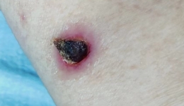 被虫子咬一口就住进了ICU， 户外活动小心恙虫病！