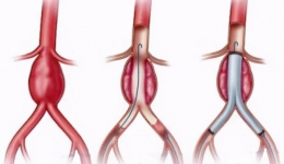 南溪山医院心脏大血管外科成功拆除体内“不定时炸弹”
