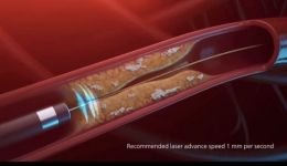 南溪山医院准分子激光治疗冠心病，为患者再添福音