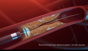 南溪山医院准分子激光治疗冠心病，为患者再添福音