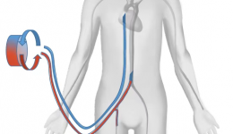 爆发性心肌炎患者危在旦夕 南溪山医院ECMO团队再创生命奇迹