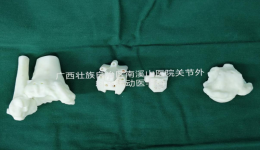 南溪山医院完成广西首例定制化人工踝关节置换