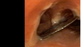 嗦螺一时爽 小心气管伤