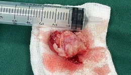 男性青春期，警惕出血性鼻咽血管纤维瘤