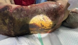 七旬老人烧伤严重，绿色通道暖心救治