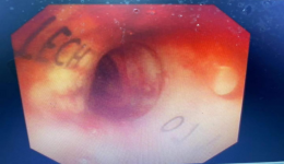 自治区南溪山医院成功开展 首例硬质支气管镜下沙漏状硅酮支架置入术