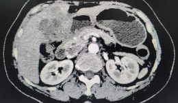 自治区南溪山医院开展荧光引导全腹腔镜下胆囊癌根治术