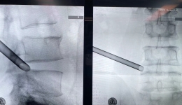 全麻内镜下精准摘除腰椎间盘突出，患者重获下肢活动自由