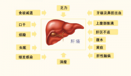 被称癌中之王的肝癌，还有得治吗？——肿瘤防治周特别篇