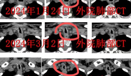 气道内置入硅酮支架，为患者撑开