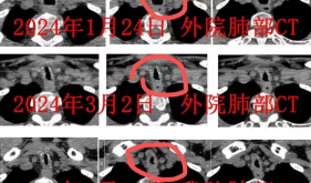 气道内置入硅酮支架，为患者撑开