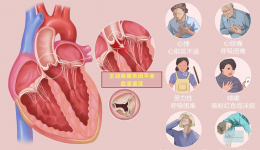 八旬重症瓣膜病患者危在旦夕，南溪山医院团队微创换瓣再创生命奇迹