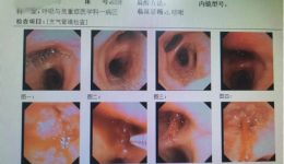 自治区南溪山医院呼吸一区采用气管支架植入术为患者开放生命通道