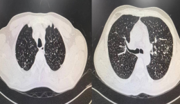自治区南溪山医院呼吸一区采用大容量肺泡灌洗术实现清洁肺部“大保健”