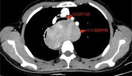 南溪山医院多学科携手攻坚，成功切除食管巨大肿瘤
