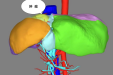 自治区南溪山医院成功开展腹腔镜下复杂中肝肿瘤切除手术