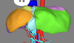 自治区南溪山医院成功开展腹腔镜下复杂中肝肿瘤切除手术