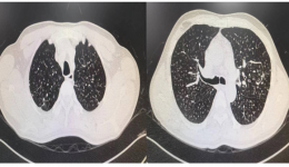 自治区南溪山医院呼吸一区通过大容量肺泡灌洗术实现肺部“大保洁”