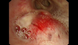 支架置入气管，“撑”开生命通道