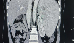自治区南溪山医院成功开展腹腔镜下原位隧道法脾脏全切术