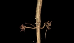 遭凶疾惊心动魄争命运 遇良医起死回升期新途 南溪山医院心脏大血管外科成功挽救危重主动脉夹层患者