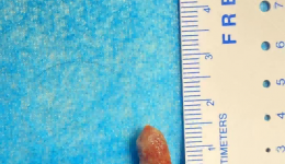 小枣核误入气道引发大问题 医生妙手使用气管镜来救命