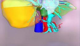 自治区南溪山医院成功实施前入路腹腔镜下右半肝切除术