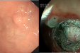 精准出刀，保“胃”健康自治区南溪山医院成功完成两例采用内镜下全层切除术（EFTR）
