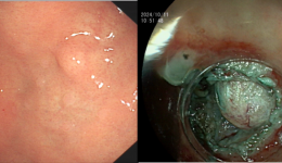 精准出刀，保“胃”健康自治区南溪山医院成功完成两例采用内镜下全层切除术（EFTR）