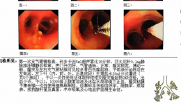 反复咳嗽竟是 胆管支气管瘘！？自治区南溪山医院肝胆胰脾外科成功完成一例胆管支气管瘘手术