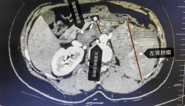 “肾癌+癌栓”威胁性命！自治区南溪山医院成功“拆弹”，患者安心回家过年