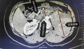 “肾癌+癌栓”威胁性命！自治区南溪山医院成功“拆弹”，患者安心回家过年